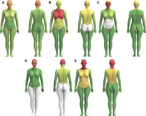 The Distribution Of Cutaneous Metastases Correlates With Local