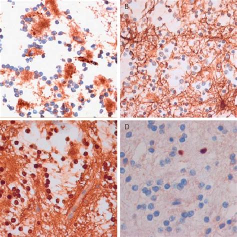 Histological Appearance Of The Rosette Forming Glioneuronal Tumor Of