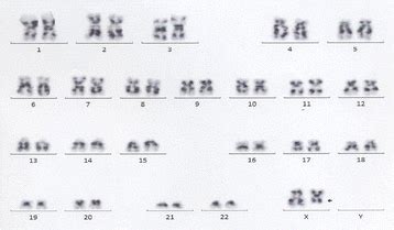 Karyotype Of Bone Marrow Cells The Karyotype Showed X Del X Q