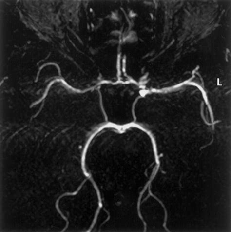 Circle Of Willis Mri