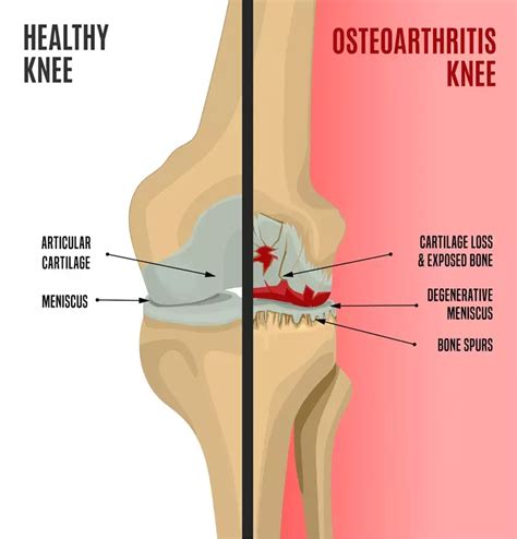 Osteoarthritic Knee Pain Center For Advanced Cardiac And Vascular