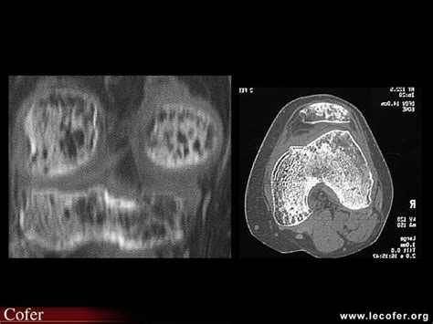 Algoneurodystrophie Algodystrophie Du Genou Tdm Diapoth Que Du Cofer