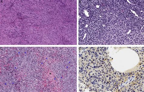 Head And Neck Mesenchymal Tumors With Kinase Fusions A Repo The