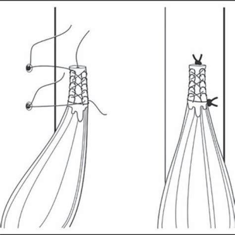 Complications after subpectoral biceps tenodesis using a dual suture ...