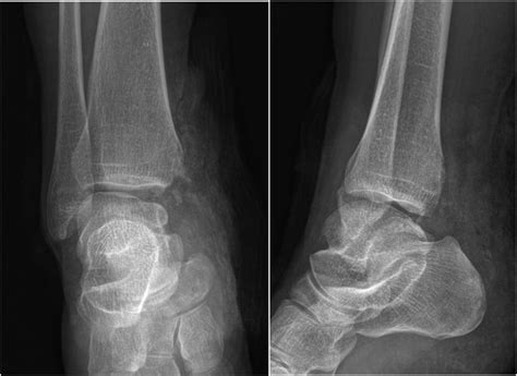 Pre-operation X ray with loss of medial malleolus. | Download ...