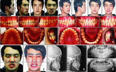 Case 2 Skeletal Class Iii Malocclusion A Pre Treatment Facial And Download Scientific