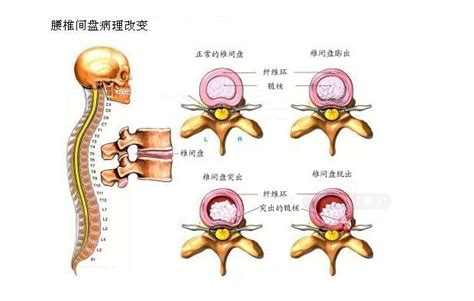 腰肌劳损和腰椎间盘突出有什么区别？ 知乎