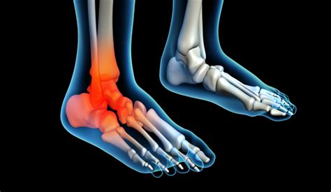 Ouch! Arthritis In Your Feet? Learn Symptoms, Causes and Treatments - ClearMatch