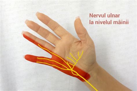 Sindromul De Canal Guyon Cu Compresia Nervului Ulnar Tratament