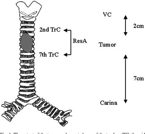 Figure 1 From Tracheal Release And Thymus Wrapping Of The Tracheoplasty