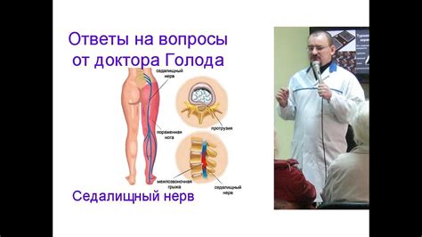 Как лечить седалищный нерв - ответ от доктора Голода - YouTube