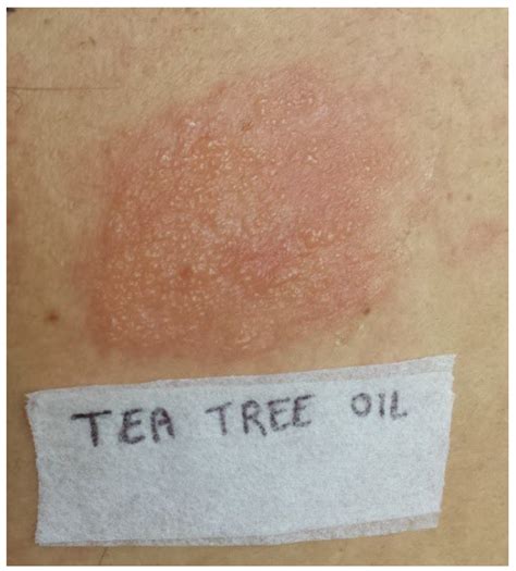 Spreading Allergic Contact Dermatitis To Tea Tree Oil In An Over The