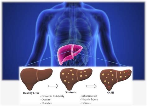 Liver Learnings: New News on NASH - BioMedWorks’ Newsletter