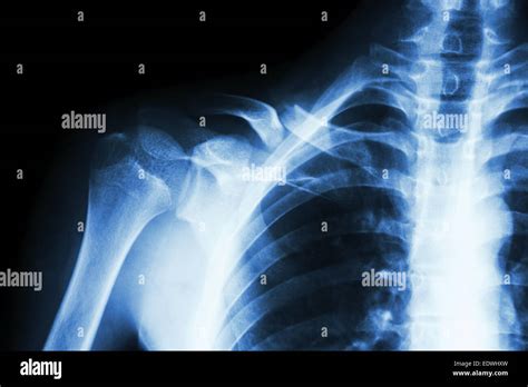 Greenstick Fracture Clavicle