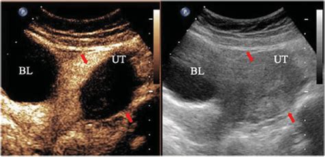 Contrast Enhanced Ultrasonography Ceus Was Immediately Performed To