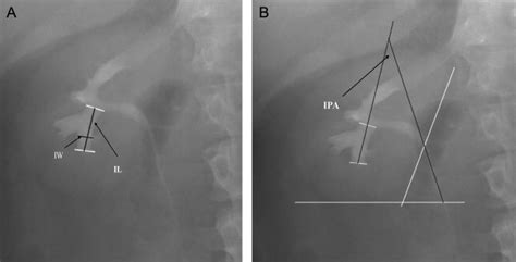 Measurement of the lower-pole calyceal anatomy. (A) Infundibular width... | Download Scientific ...