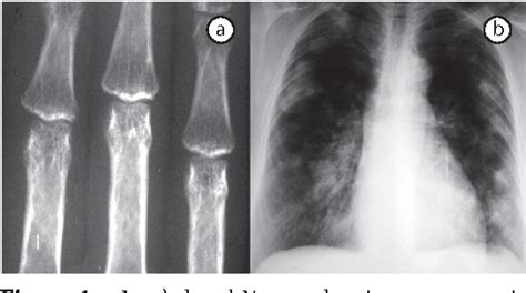 Figure 1 From Rheumatoid Pneumoconiosis Caplans Syndrome With A