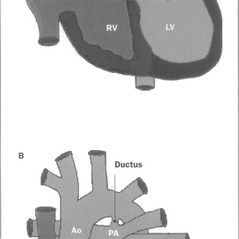 The Anatomy Ofpulmonary Valve Atresia With Intact Ventricularseptum And