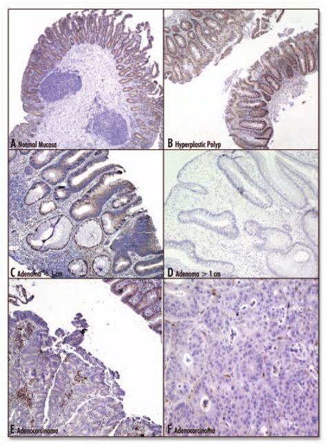 TSP 1 Immunohistochemistry Of Human Colonic Tissue Samples A Normal