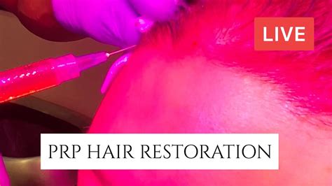 Platelet Rich Plasma For Hair Loss Prp Hair Restoration Live