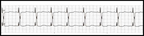 Float Nurse Various Biventricular Paced Rhythms