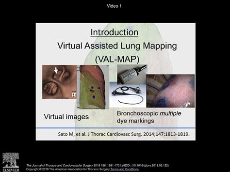 Effect Of Virtual Assisted Lung Mapping In Acquisition Of Surgical