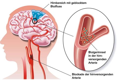 Schlaganfall Ursachen Symptome Erkennung Und Behandlung Wie