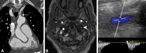 Subclavian Artery Anatomic Review And Imaging Evaluation Of Abnormalities Radiographics