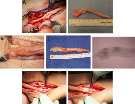 Diagnosis And Operative Treatment Of Peroneal Tendon Tears Pmc