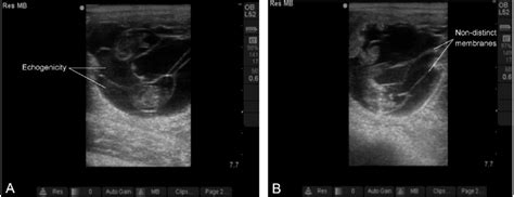 Ultrasonographic images of the presumed monozygotic twins at days 45 ...