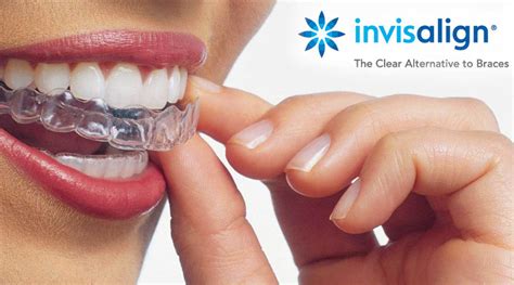 Aparaty Ortodontyczne Invisalign Warszawa Smile Design Clinic