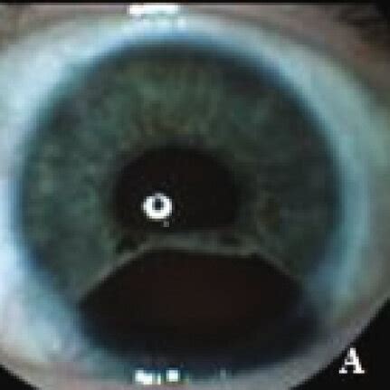 (a, b) Iris coloboma of the left eye following surgical treatment for ...