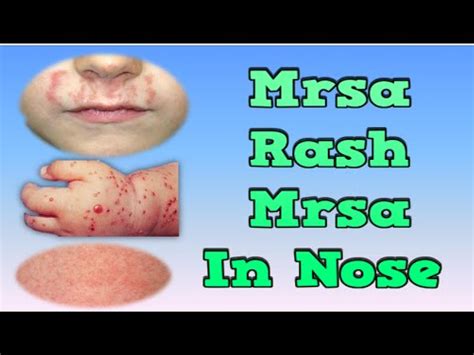 What Is Mrsa Infection