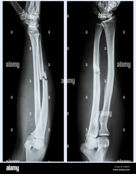 X Ray Forearm Front Side Comminuted Fracture Shaft Of Ulnar