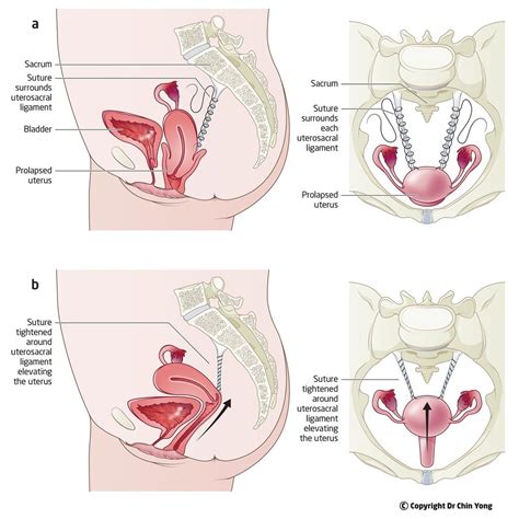 Uterine Preservation Surgery Melbourne — Dr Chin Yong