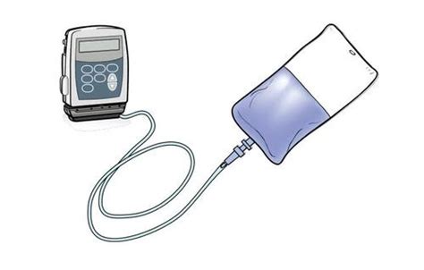 What To Know About Ambulatory Infusion Pump