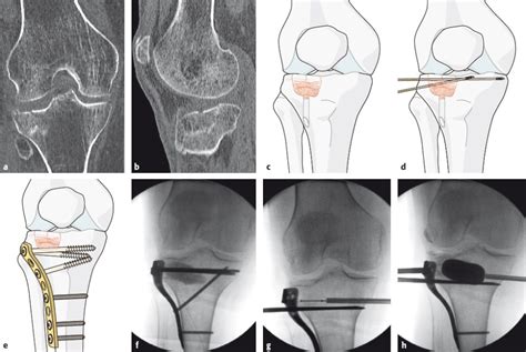 3 15 Proximal Tibia Musculoskeletal Key