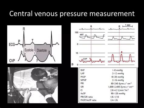 Basic Hemodynamic Monitoring For Nurses Ppt