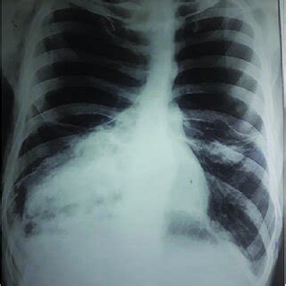 Pdf Tension Pneumothorax Mimicking Giant Bullae Associated With