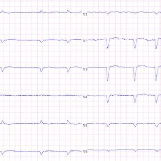 Electrocardiogram Of Patient Showing Atrial Fibrillation With Slow