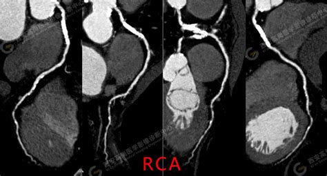 医学影像之冠状动脉ct血流储备分数ai定量分析（ct Ffr）医学影像血流储备定量分析 健康界