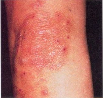 Anemia Skin Rash