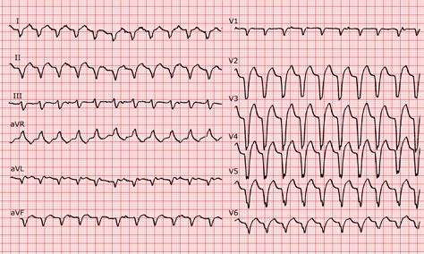 Av Nodal Reentrant Tachycardia