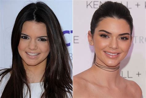 Kendall Jenner Before and After Plastic Surgery