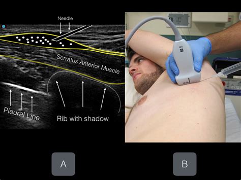 Serratus Anterior Plane (EASY) — Highland EM Ultrasound Fueled pain ...