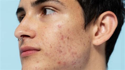 La Importancia Del Cuidado Dermatológico En Niños Y Adolescentes