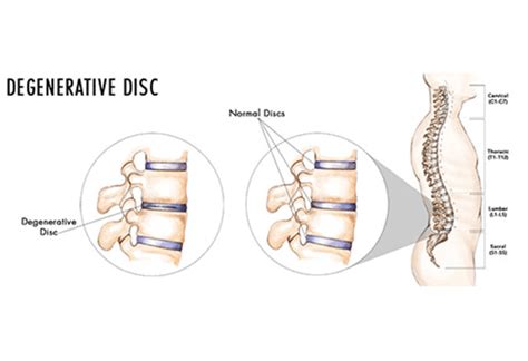 Degenerative Disc Disease Ddd Bonati Spine Institute