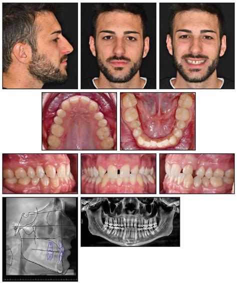 Tandem Skeletal Expander And Mapa Protocol For Palatal Expansion In