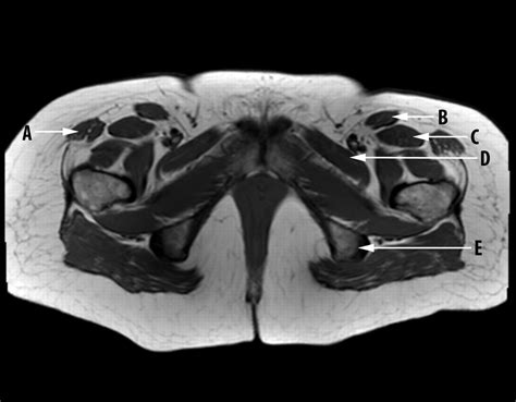 Magnetic Resonance Image Of The Pelvis The Bmj