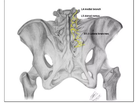 Sacroiliac Joint fusion | PPTX